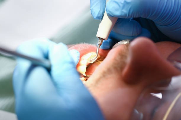 Best Broken or Chipped Tooth Repair in Wallenuck Lake Estates, PA